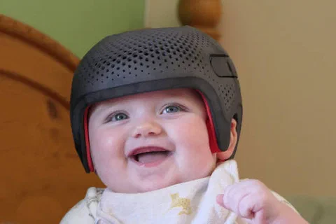 A smiling baby girl wearing a cranial remolding helmet